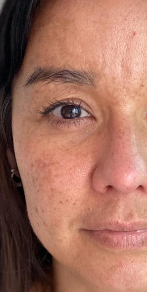 antes_melasma.webp antes_melasma.webp